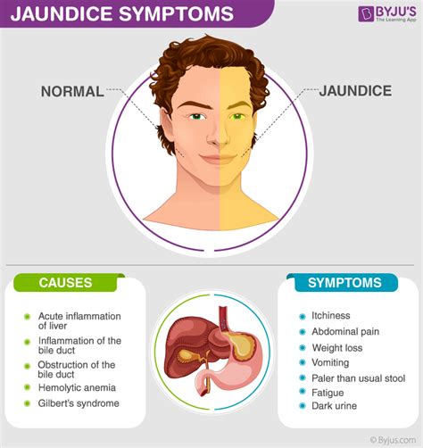 Spot the Signs of Jaundice Before It's Too Late: Don't Take the Risk!